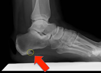 heel bone spur causes