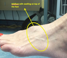 Ganglion cyst on foot: Pictures, cause, symptoms, and treatment