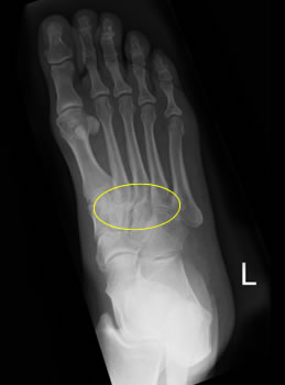 Midfoot Arthritis Xray